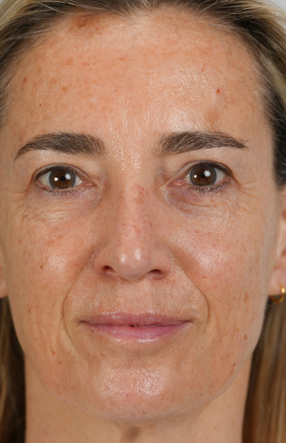 Image d’avant/après